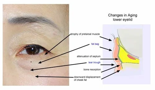 Anatomy of eye-bag