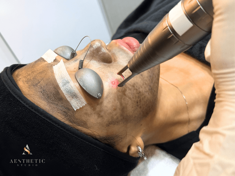 Carbon laser peel treatment procedure using Spectra laser on patient in clinic