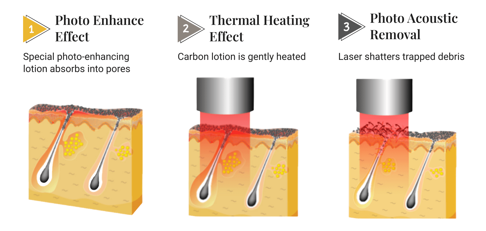 Infographic showing how Carbon Peel Laser, Spectra Peel, and Hollywood Peel work: carbon lotion application, Spectra laser thermal effect, and Q-switched peeling effect for clearer, brighter skin in Singapore