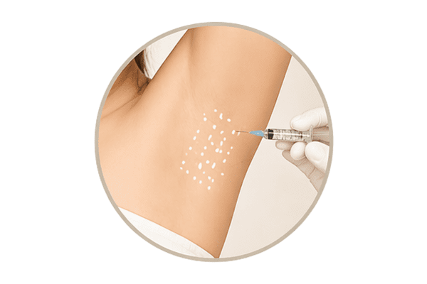 Botulinum toxin treatment for excessive sweating in underarms Singapore