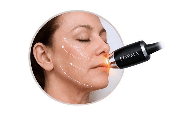 InMode Forma treatment for loss of facial contour and structure in the mid-face and lower face