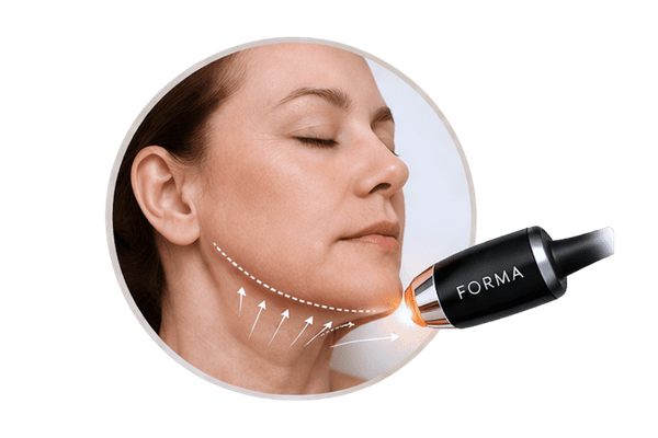 InMode Forma treatment for jawline definition and early jowls under the chin using RF skin tightening