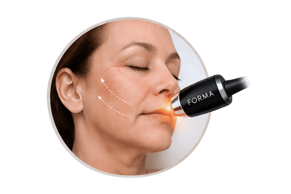 InMode Forma RF skin tightening treatment targeting mild skin laxity and early sagging in the cheeks and lower face