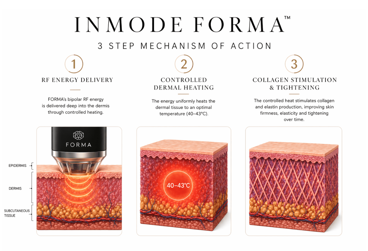 InMode Forma RF skin tightening 3 step mechanism showing radiofrequency energy delivery controlled dermal heating and collagen stimulation