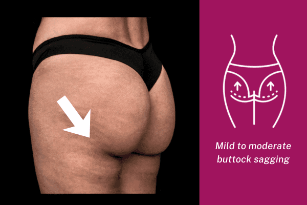 Mild buttock sagging with lower-set contour before Sculptra butt lift treatment