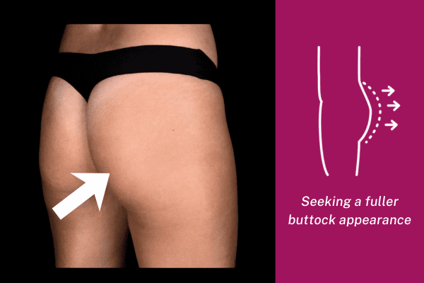 Fuller buttock shape and improved contour after Sculptra butt lift treatment