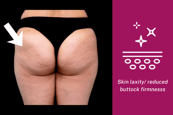 Buttock skin laxity with reduced firmness before Sculptra collagen treatment
