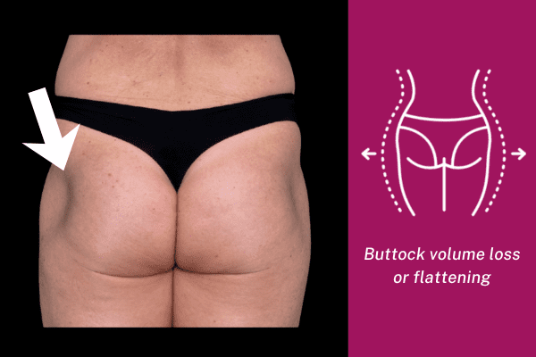Flattened buttock shape with reduced projection before Sculptra butt lift