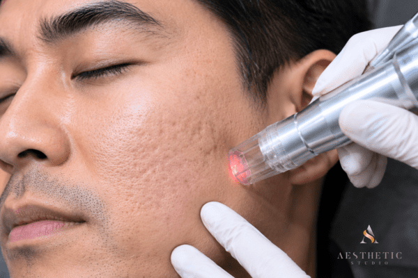 Fractional CO2 laser treatment being performed on acne scars using a resurfacing laser device