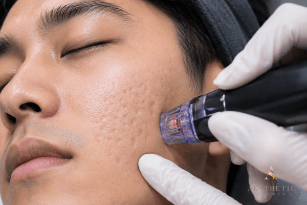 RF microneedling treatment being performed on acne scars using Morpheus8 device