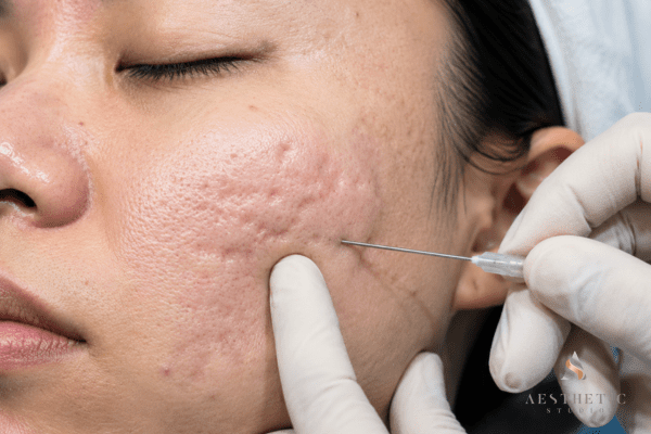 Close-up of subcision procedure being performed for rolling acne scars on the cheek