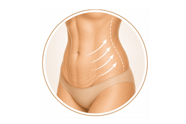Illustration showing skin laxity and contour changes following significant weight loss in a Sculptra body treatment area.