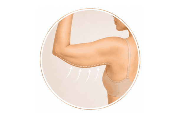 Illustration showing body contouring treatment for the upper arms to improve arm definition and contours.