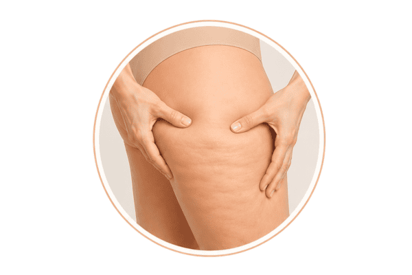 Illustration of Grade 1 mild cellulite showing fine dimpling that becomes visible when the skin is gently pinched.