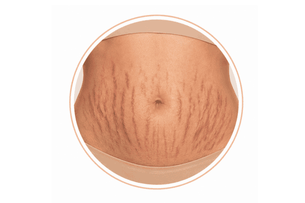 Clinical illustration showing red stretch marks (striae rubrae) on the abdomen during the early stage of stretch mark development.