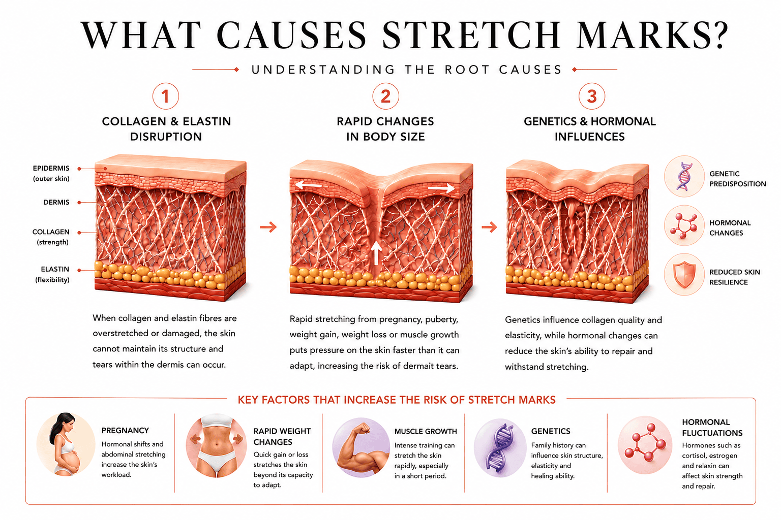Medical infographic illustrating what causes stretch marks, including collagen and elastin disruption, rapid body size changes, genetics, hormonal influences, pregnancy, weight fluctuations and muscle growth