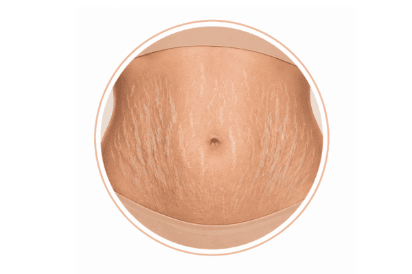 Clinical illustration showing white stretch marks (striae albae) on the abdomen during the mature stage of stretch mark development.