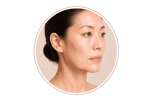 Asian woman with loose-looking lower-cheek skin and a softened jawline after weight loss