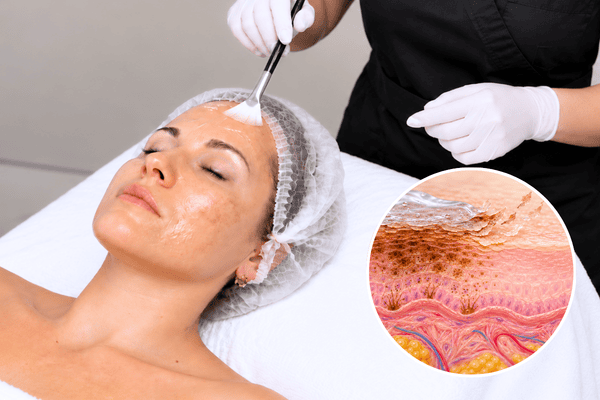 Chemical peel treatment for facial pigmentation and surface dark spots