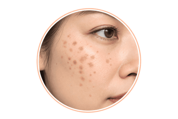 Hori’s naevus appearing as small clustered spots on the cheek