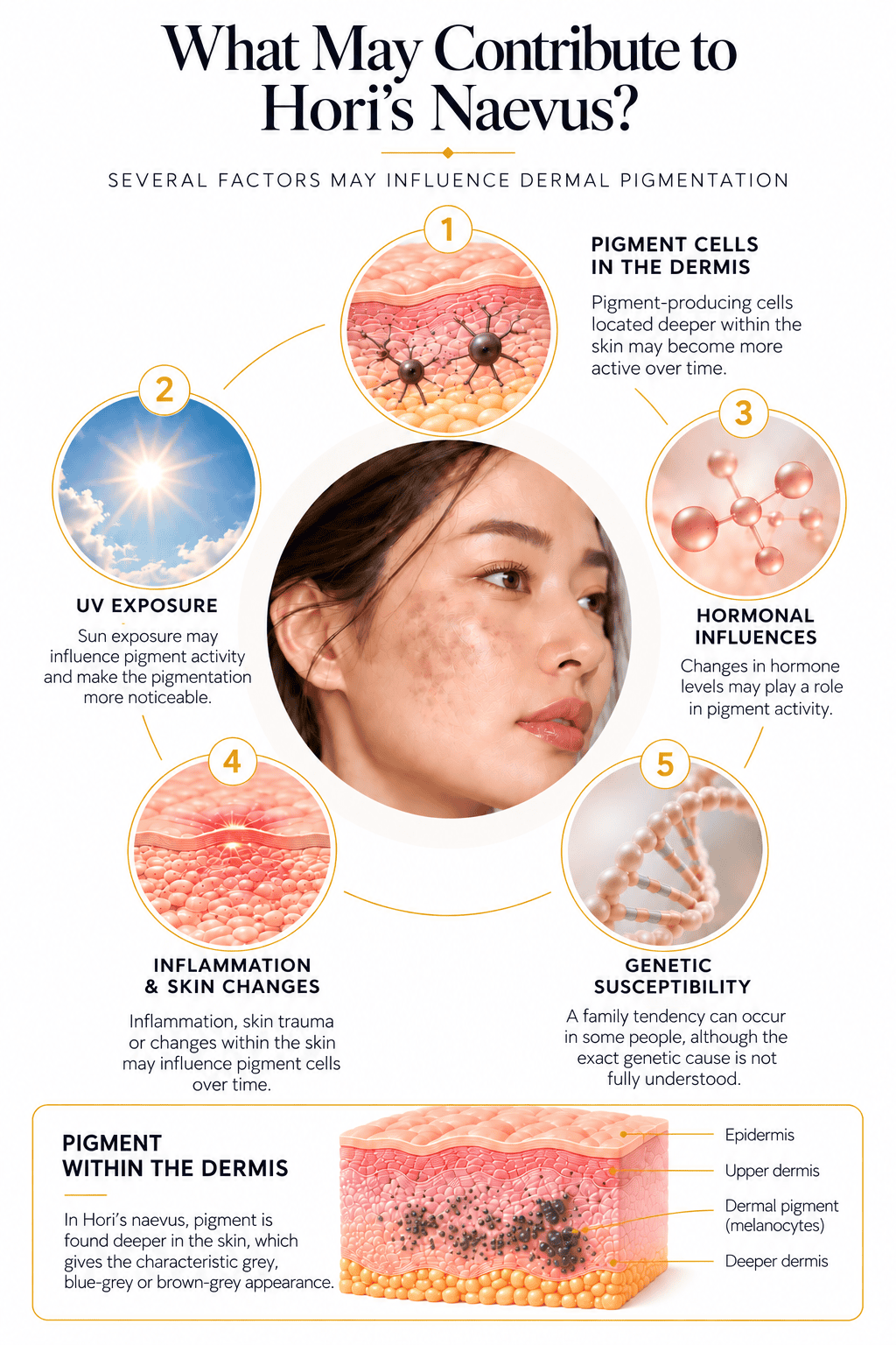 Infographic showing factors that may contribute to Hori’s naevus, including dermal pigment cells, UV exposure, hormones, inflammation and genetics