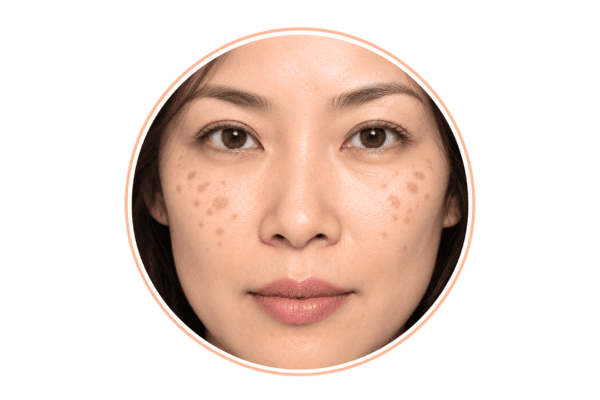 Hori’s naevus pigmentation appearing on both cheeks