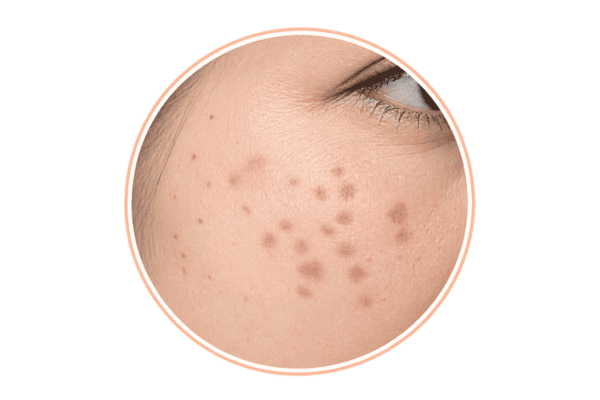 Hori’s naevus appearing as grey-brown pigmentation on the cheek