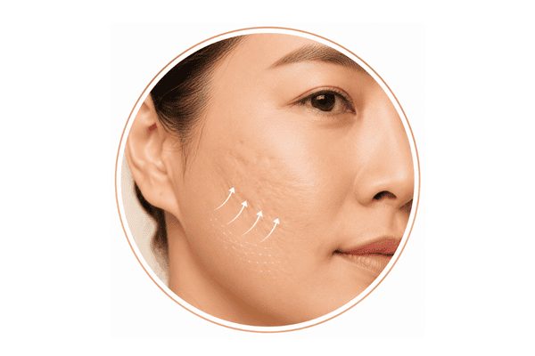 Asian woman’s cheek with depressed acne scars and upward collagen-remodelling arrows