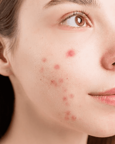 Acne Scar